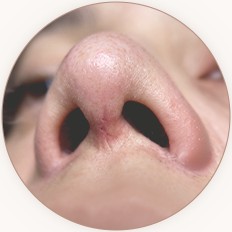 수술 후 붉은 절개선
